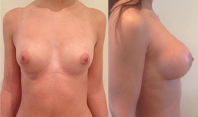 Breast enlargement tunisia with anatomic implants