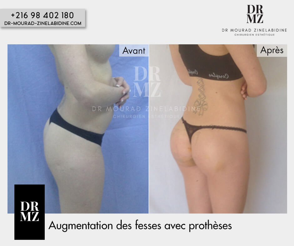 Buttock augmentation Tunisia