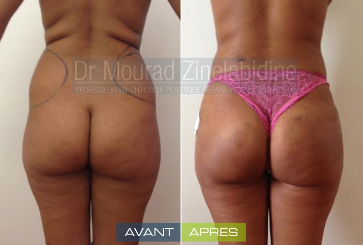 Photos lipofilling fesses Tunisie