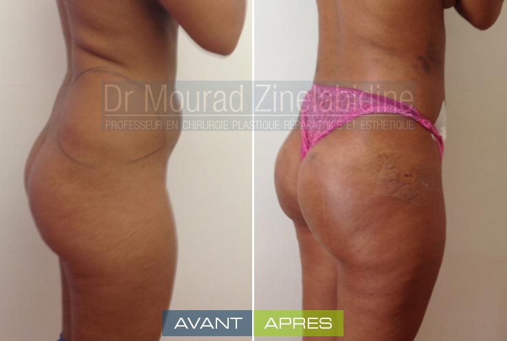 Photos lipofilling fesses Tunisie