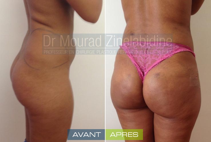 Photos lipofilling fesses Tunisie