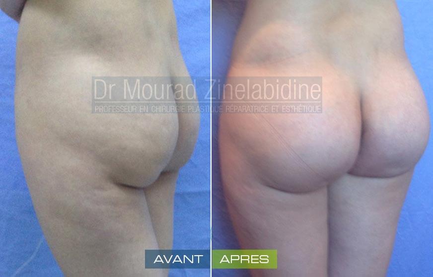 Photos augmentation fesses Tunisie