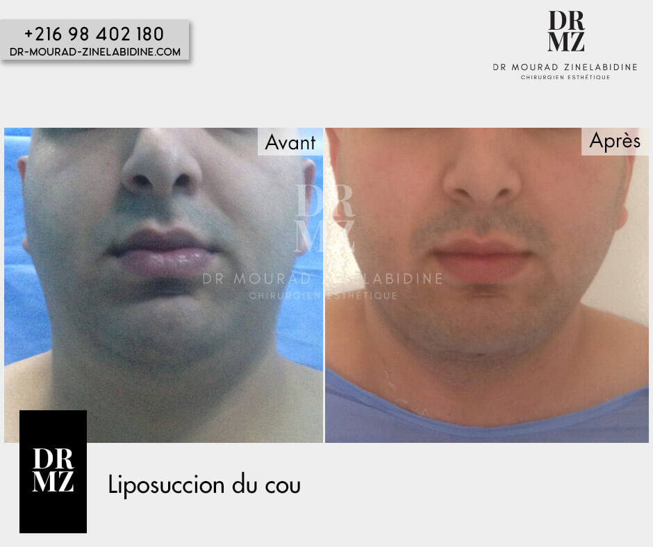 Lifting visage Tunisie
