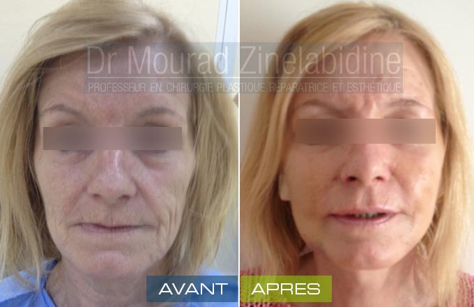 Lifting visage Tunisie