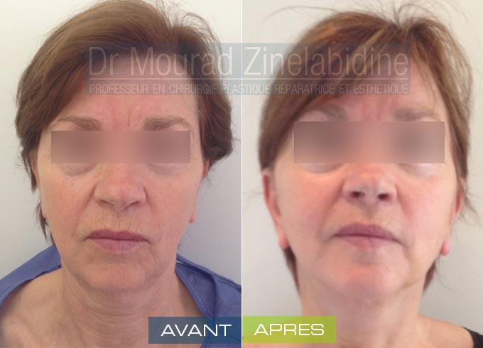 chirurgie visage Tunisie