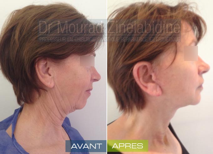 lifting facial