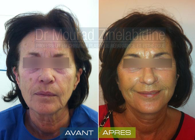 Lifting visage Tunisie