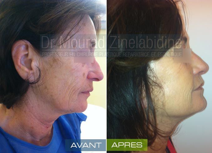 Lifting visage Tunisie
