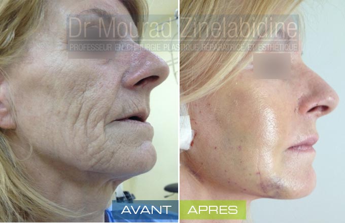 Lifting cervico facial Tunisie