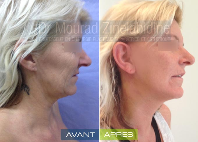 chirurgie visage