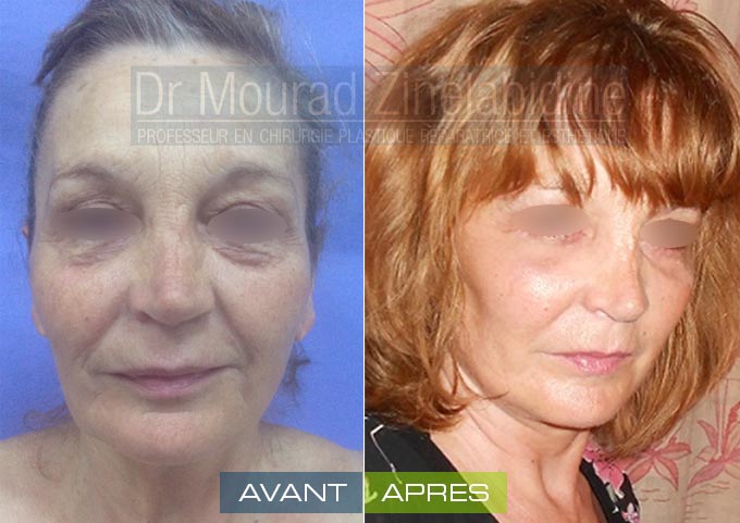 Lifting visage Tunisie
