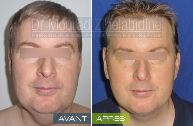 Lifting visage Tunisie