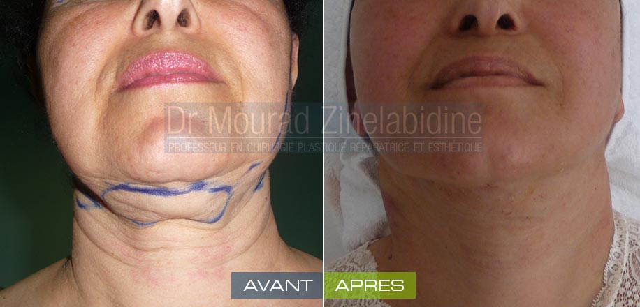 Lifting visage Tunisie