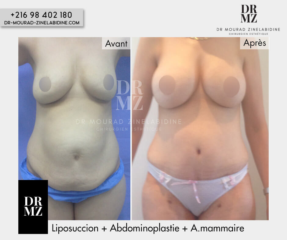 Photos liposuccion Tunisie