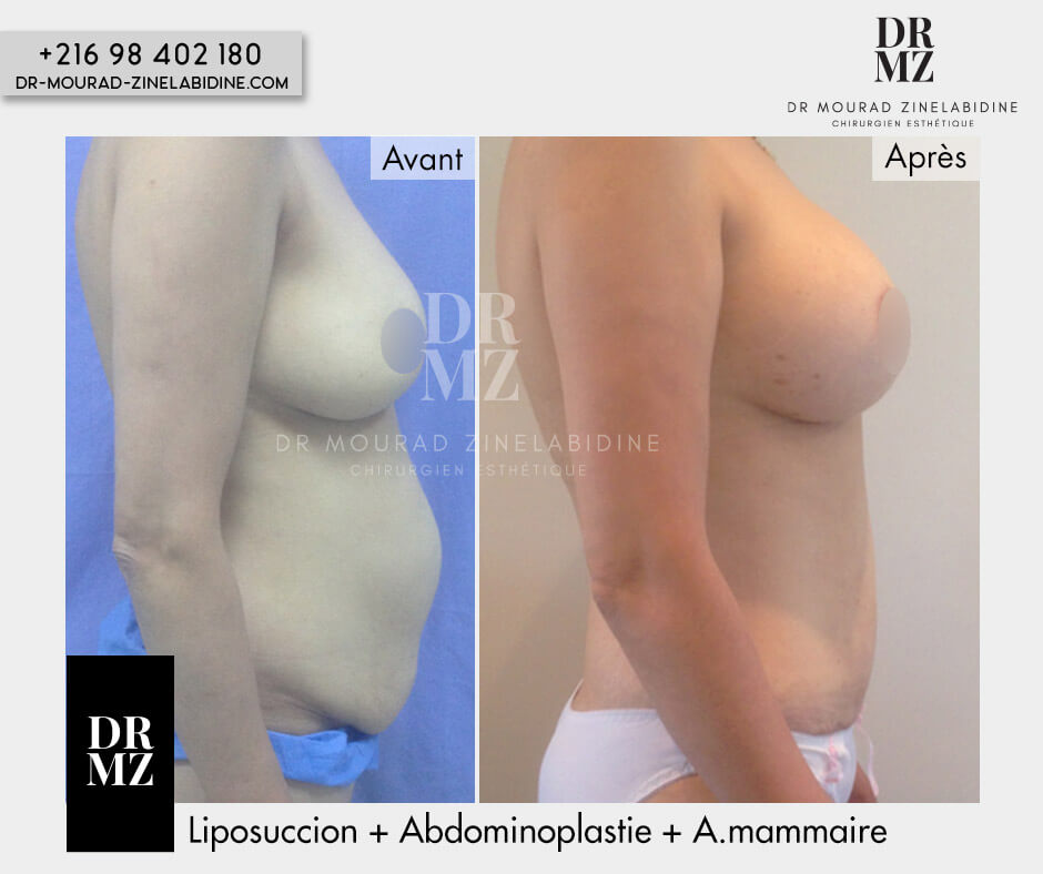 Photos liposuccion Tunisie