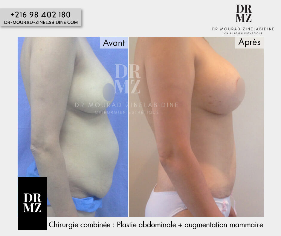 Photos abdominoplastie Tunisie