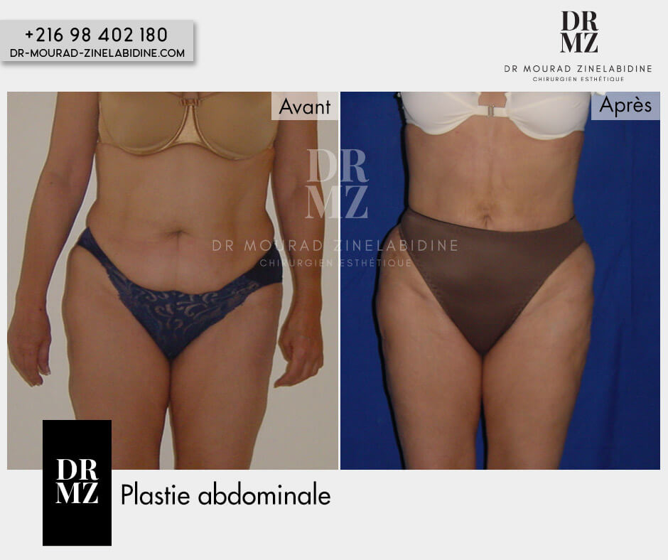 Photos abdominoplastie Tunisie