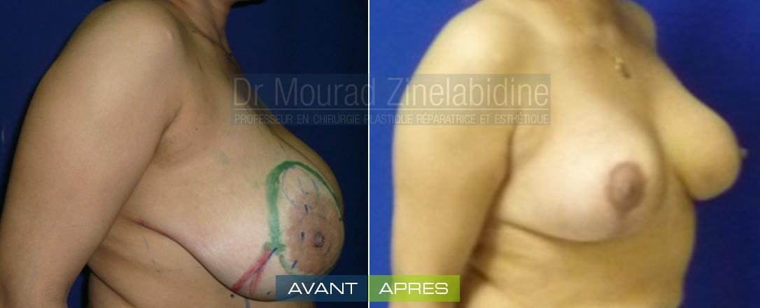 Photos reduction mammaire Tunisie