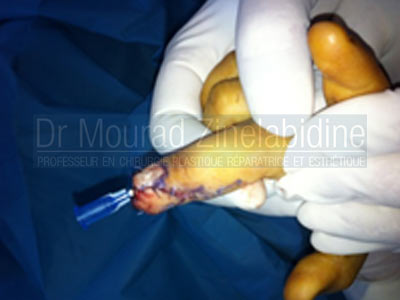 Amputation réimplantation main Tunisie