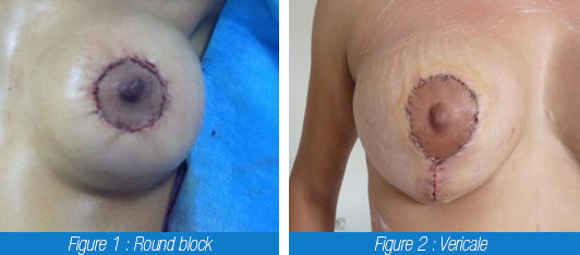 Lifting seins Tunisie