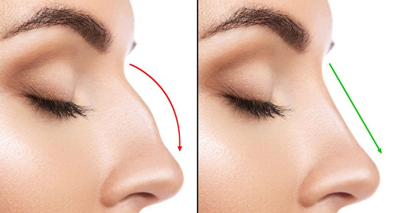 rhinoplastie Tunisie 