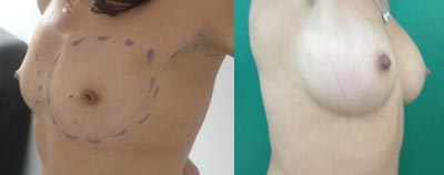 Breast augmentation tunisia with round implants