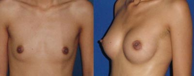 Breast enlargement tunisia with anatomic implants