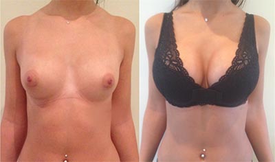 Breast augmentation tunisia with anatomic implants