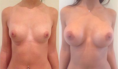 Breast enlargement tunisia with anatomic implants