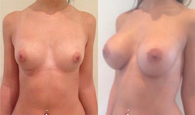 Breast augmentation tunisia with anatomic implants