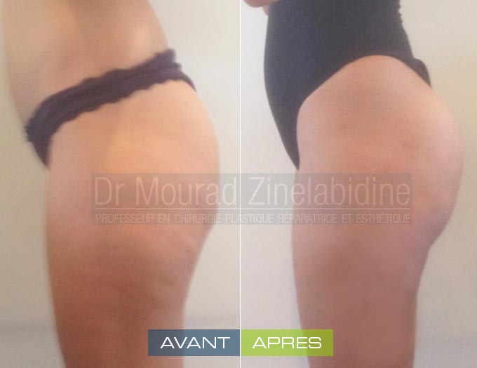 Buttock fat transfer Tunisia