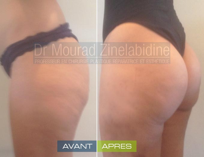 Buttock fat transfer Tunisia