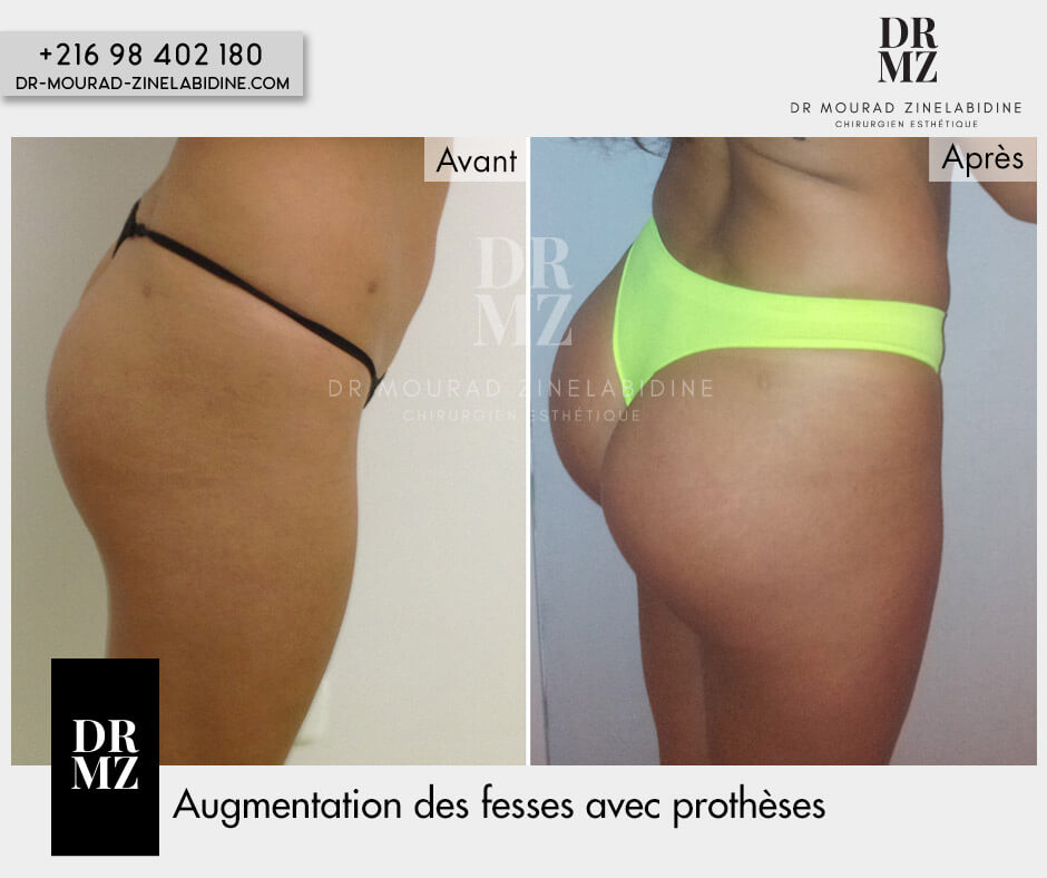 Buttock augmentation Tunisia