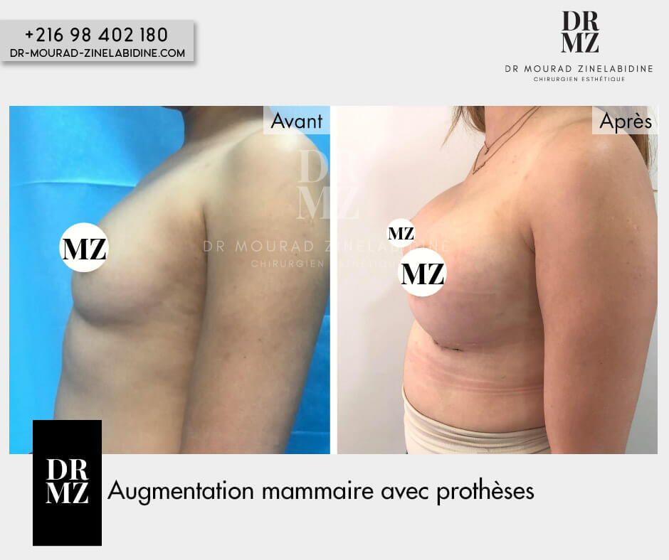 Photo avant & après augmentation mammaire
