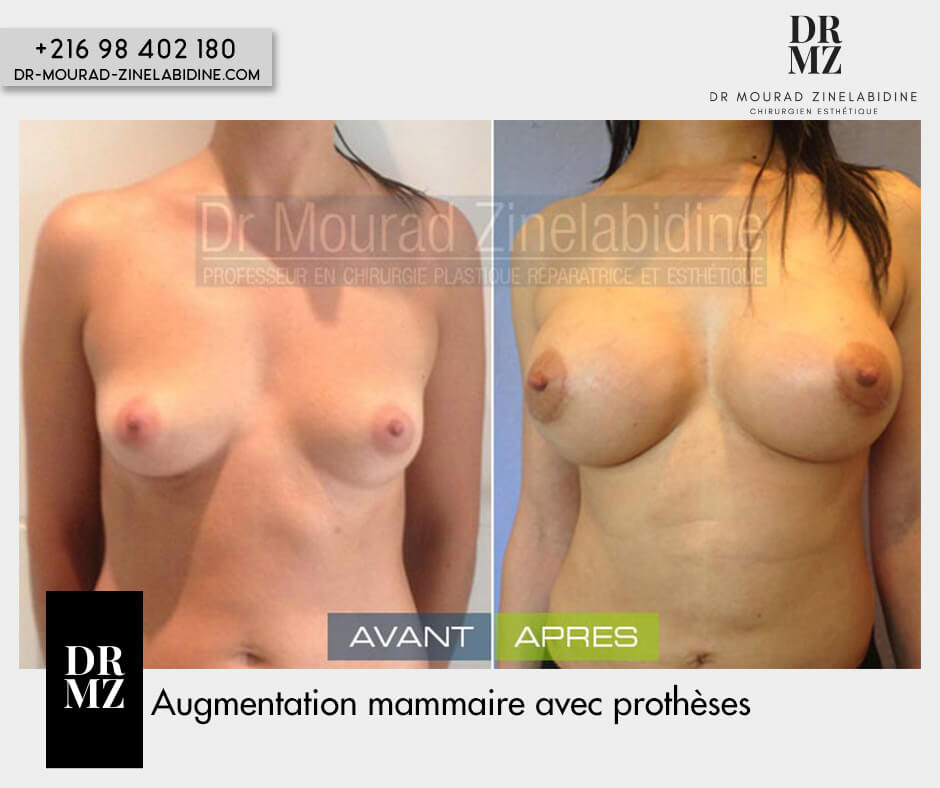 combined surgery, liposuction