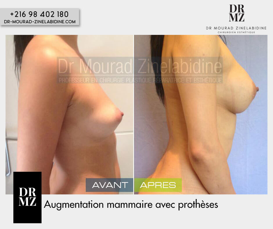 combined surgery, liposuction
