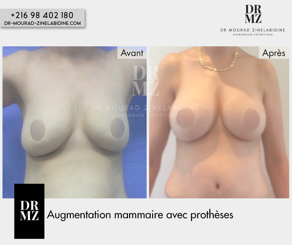 breast implant removal and replacement Tunisia