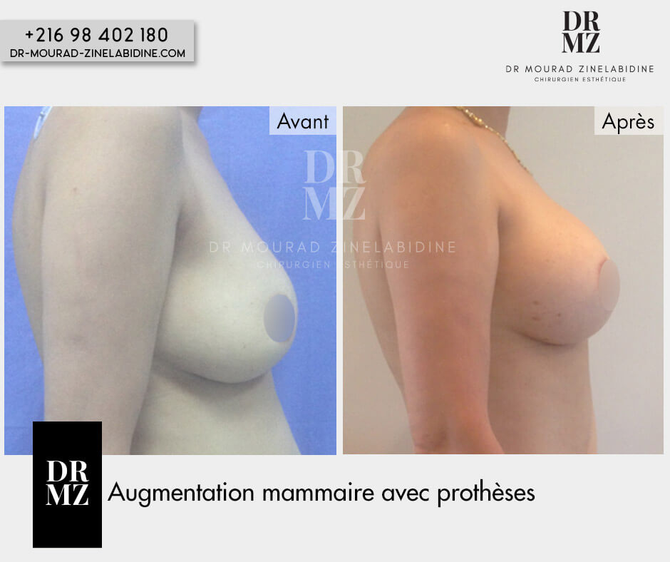 breast implant removal and replacement Tunisia