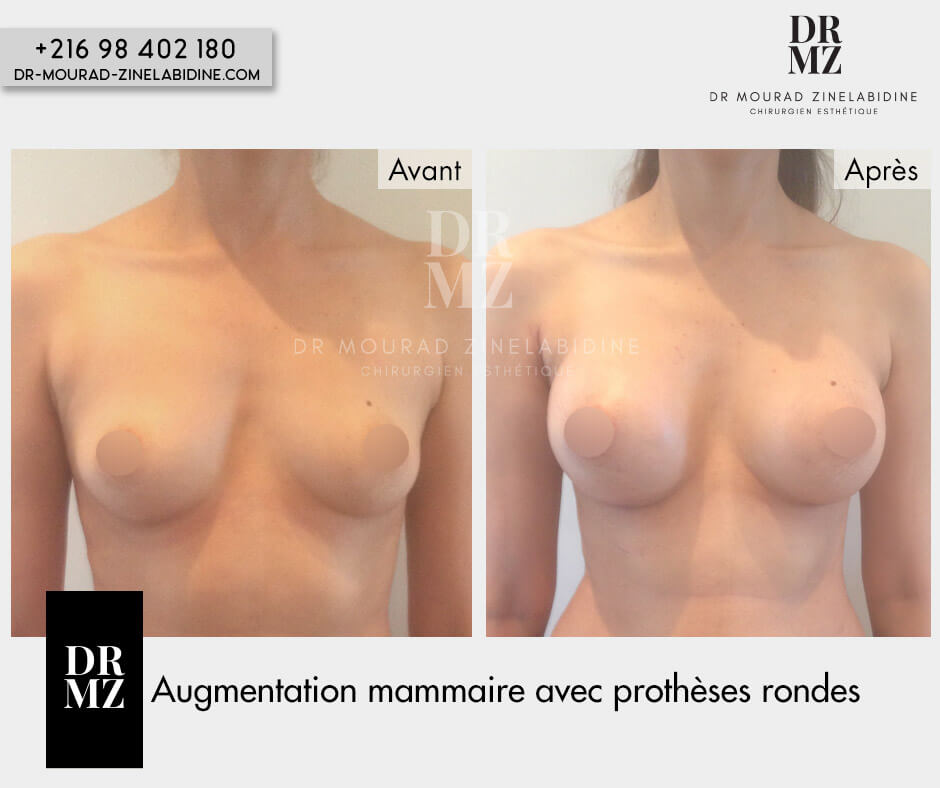 Breast enlargement by Lipofilling Tunisia