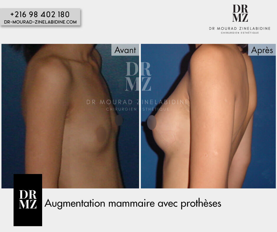 Photo avant & après augmentation mammaire