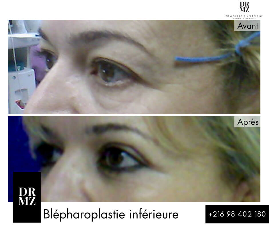Photo avant & après blépharoplastie