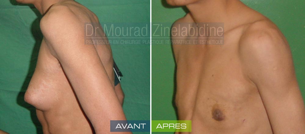 Photo avant & après gynécomastie