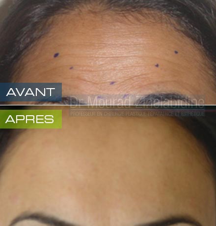 Photo avant & après botox