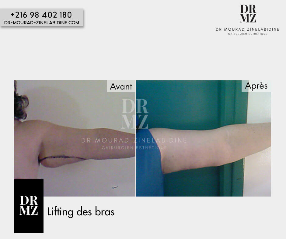 Photo avant & après lifting des bras
