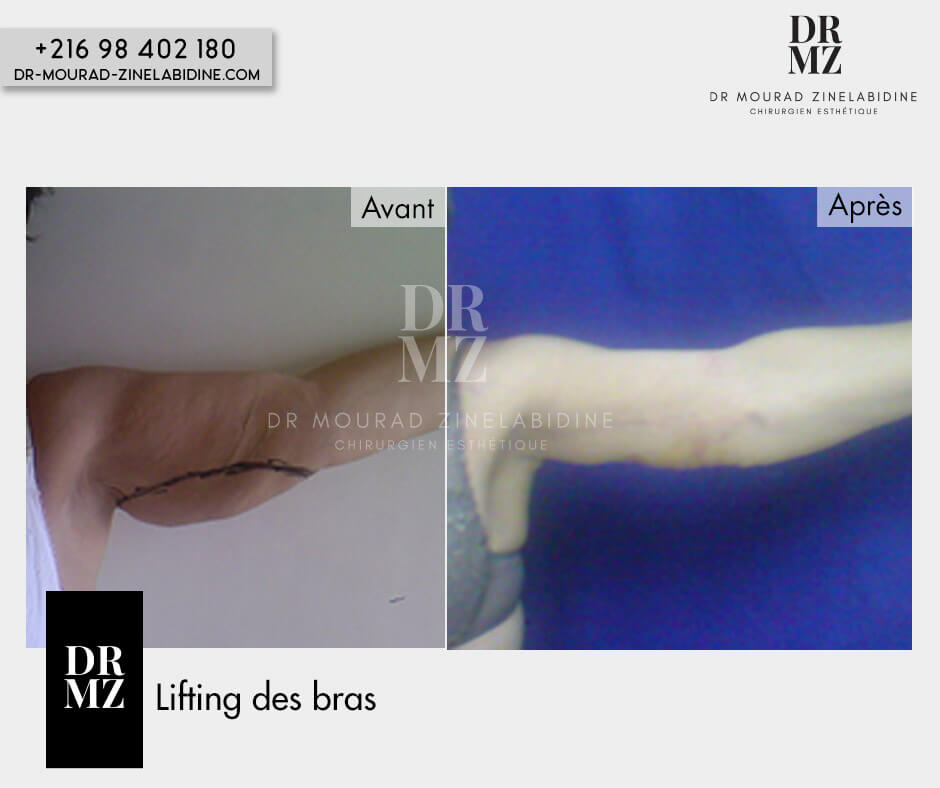 Photo avant & après lifting des bras