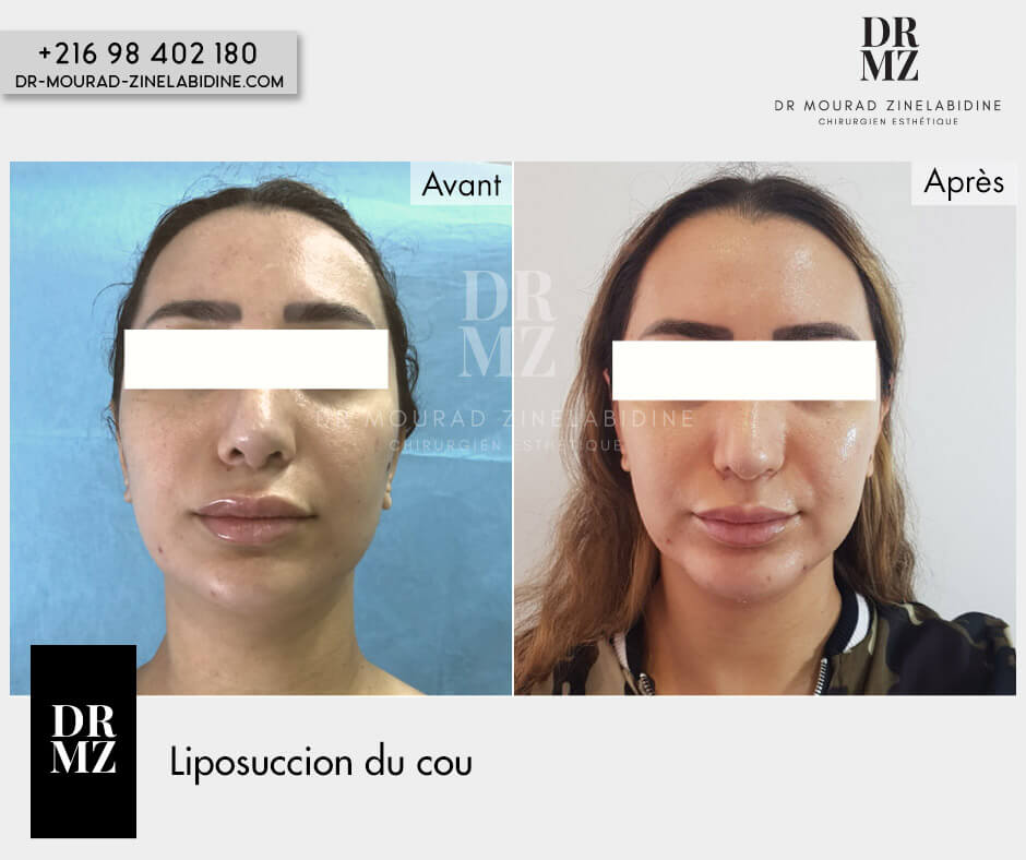 Photo avant & après liposuccion du cou