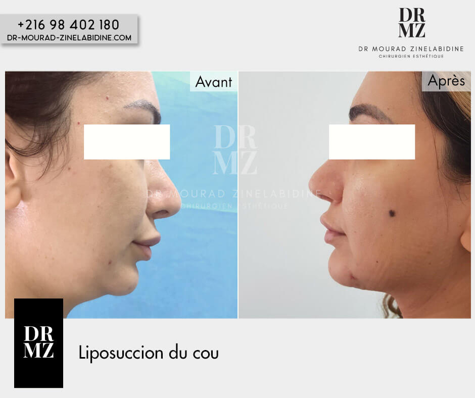 neck Liposuction Tunisia