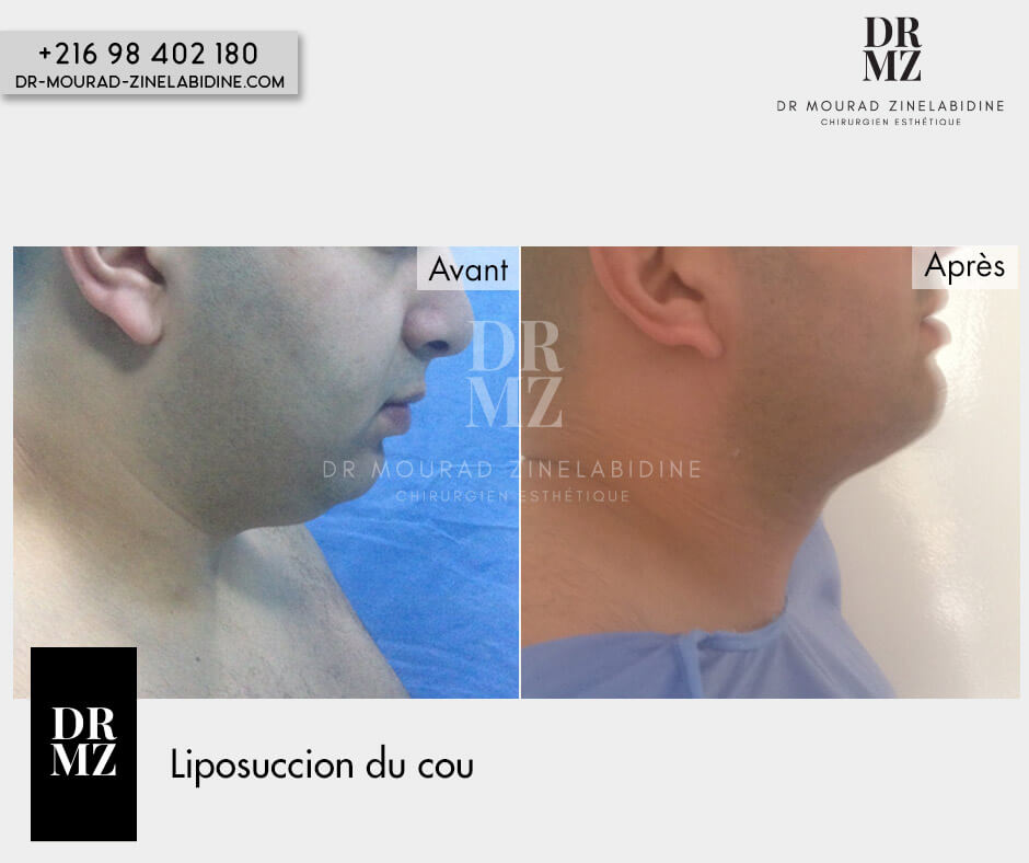Photo avant & après liposuccion du cou