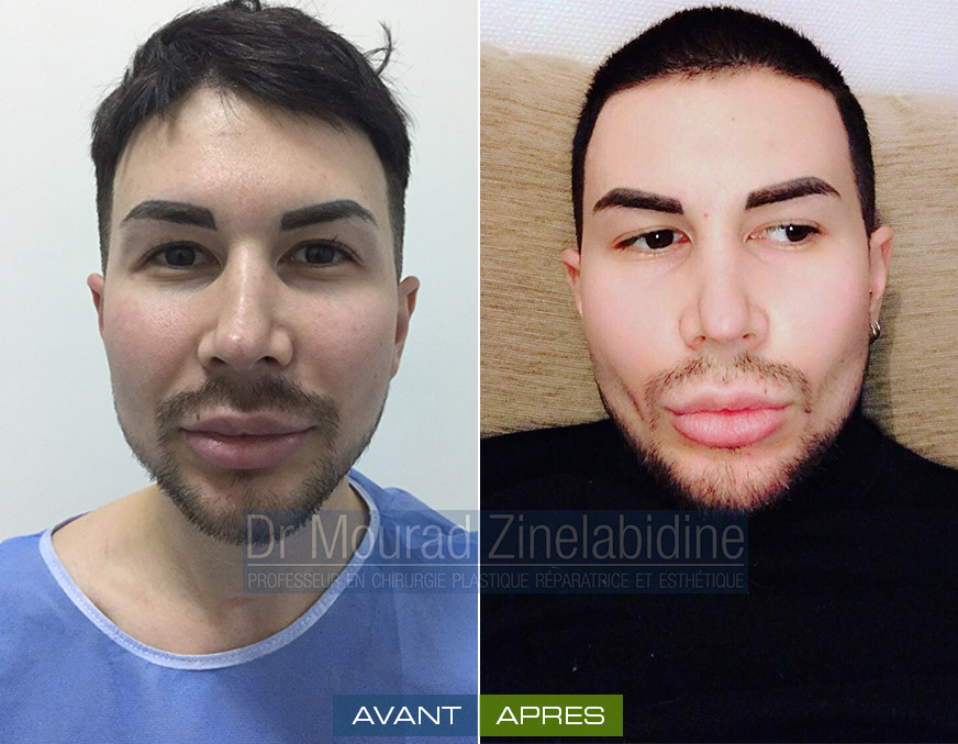 Photo avant & après chirurgie fossettes