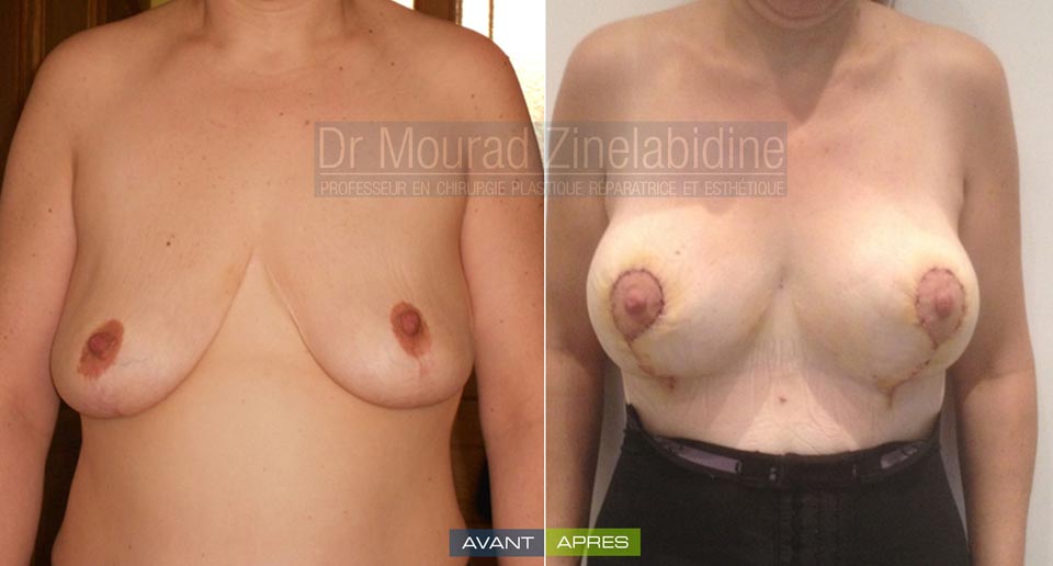 Photo avant & après lifting des seins (avec prothèses)